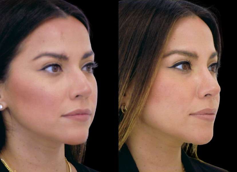 Rhinoplasty Before and After Photo Dr. Alfred Cohen in Beverly Hills, CA