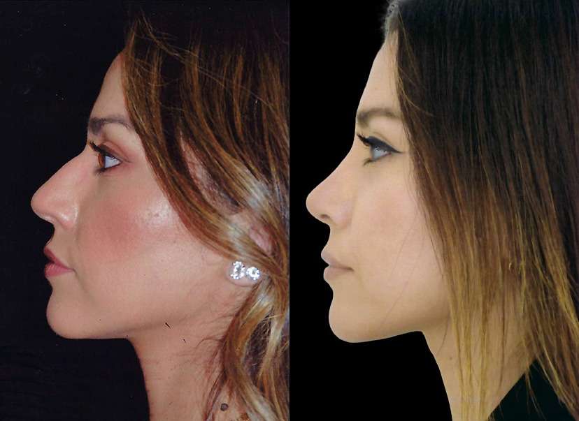Rhinoplasty Before and After Photo Dr. Alfred Cohen in Beverly Hills, CA